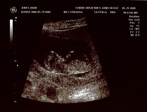 May 29 Ultrasound image 1